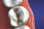 Inlays to the natural tooth structure